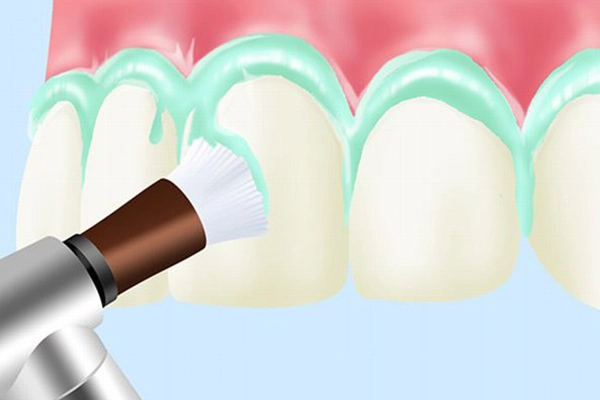 PMTC(Professional Mechanical Tooth Cleaning)